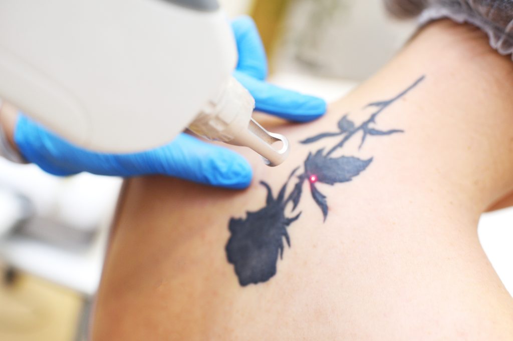eliminación de tatuajes