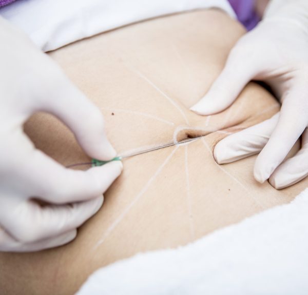 Aesthetic surgery, mesothreads, lifting
